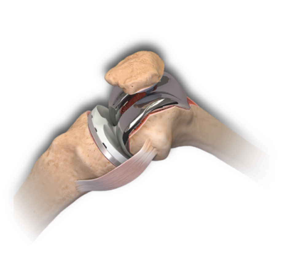 totale-knie-prothese-orthopedisch-centrum-limburg